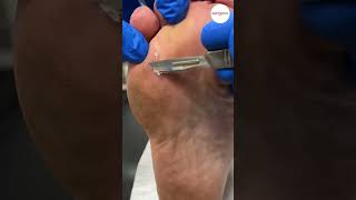 Neuroma Surgery Scar Debridement [upl. by Essined]