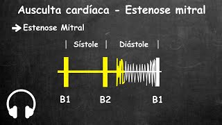 Ausculta cardiaca estenose mitral e insuficiencia mitral [upl. by Ecyle]