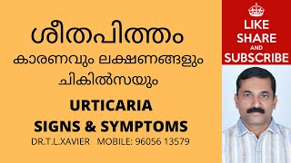 ശീതപിത്തം  How to Treat Urticaria Signs Symptoms amp Simple Tips Dr T L Xavier [upl. by Acinnod]