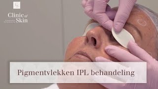 Pigmentvlekken IPL behandeling [upl. by Jak697]