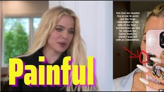 Khloe Kardashian revealed her disfigured face with extremely scary injuries [upl. by Hedvige]