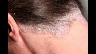 How to Treat Scalp Scabs [upl. by Trueman]