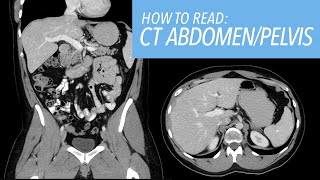 How to Read a CT Abdomen amp Pelvis like a Radiologist Introductory Approach and Basic Search Pattern [upl. by Candy]