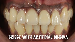 DENTAL BRIDGE WITH ARTIFICIAL GINGIVA [upl. by Silber]