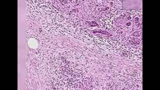 Histopathology PancreasAdenocarcinoma [upl. by Smada]