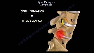 Low Back pain Lumbar disc herniation causes diagnosis symptoms and treatment [upl. by Magdaia]