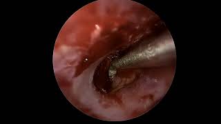 Ear drum repair tympanoplasty with lateral graft [upl. by Ballman]