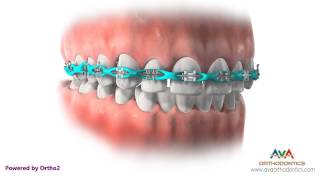 Space Closure by Power Chain  Orthodontic Treatment [upl. by Sissel]