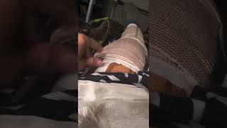 Right Leg Snapped broken both bones in the leg physicaltherapy permanently [upl. by Ayram]