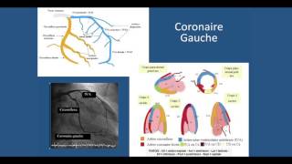 Coronarographie et Angioplastie coronaire [upl. by Revolc]