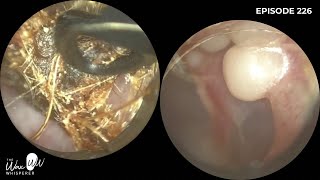 226  Hearing Aid Wax Filter Removed and Periosteum Refrigeration Exostosis Revealed [upl. by Gilligan]