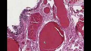 Histopathology Anus Hemorrhoids [upl. by Sigismund]