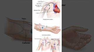 Central venous catheter nursing biology nursingcareers aiims nursing [upl. by Koenraad]