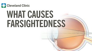 What Causes Farsightedness [upl. by Ennagrom218]