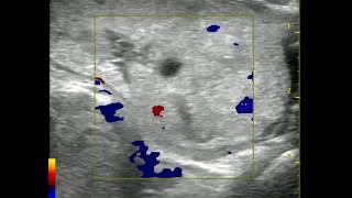 Thyroid Ultrasound [upl. by Yotal]