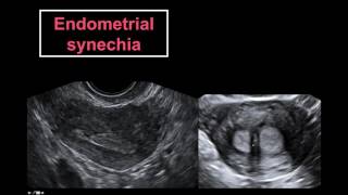 Ultrasound Based Complete Evaluation of the Infertile Patient in a Single Visit [upl. by Guerin229]