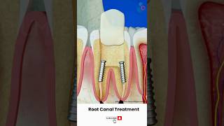 Root Canal Treatment Procedure ↪ 3D Medical Animation Shorts RootCanal Tooth [upl. by Thill389]