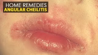 Angular Cheilitis  Home Remedies Natural Treatment  Health Education [upl. by Gaskill894]