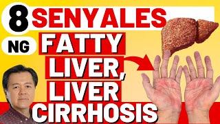 8 Senyales ng Fatty Liver Liver Cirrhosis  By Doc Willie Ong Internist and Cardiologist [upl. by Simpson]