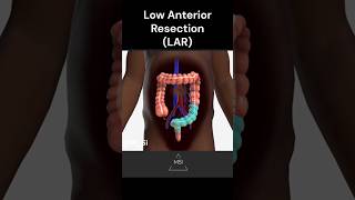 Low Anterior Resection LAR [upl. by Ellehciram]