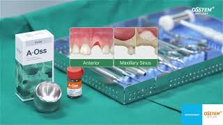 AOSS Osstem Implant bovine xenograft luudutusmateriaali [upl. by Darcey]