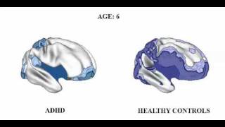 Brain matures a Few Years Late in ADHD but follows Normal pattern [upl. by Gentry]