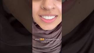 Composite bonding on four teeth only by Dr Pete 🙌 viral dentalbonding [upl. by Siradal286]