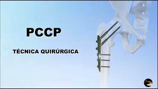 PCCP Técnica Quirúrgica [upl. by Innavoj]