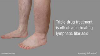 Tripledrug treatment is effective in treating lymphatic filariasis [upl. by Eizzil240]