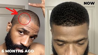 How to derma roll for thinning hairline and corners [upl. by Eiffe]