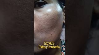 Day20 Using Tretinoin 0025 cream viralvideo tretinoin skincare shorts youtubeshorts [upl. by Anaytat]