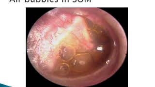 Otitis Media with Effusion  ENT Lecture Series [upl. by Gebhardt]