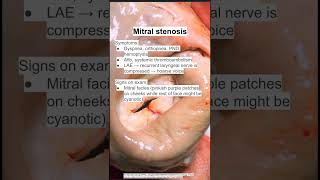 Mitral stenosis [upl. by Hsemar]