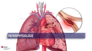 ESC Lungenembolie Leitlinie 2019 Epidemiologie prädisponierende Faktoren Pathophysiologie [upl. by Le580]