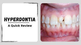 What is Hyperdontia  Extra Teeth [upl. by Jaymie]