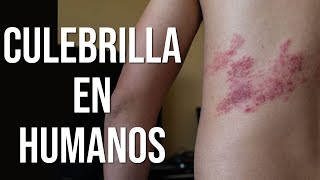 Culebrilla en humanos  Explicación médica [upl. by Sharlene]