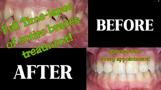 Braces  before and after slideshow timelapse [upl. by Erastus]