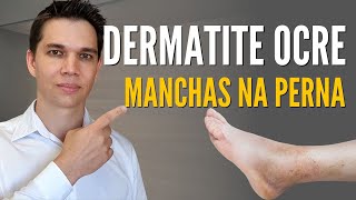 DERMATITE OCRE Como clarear as manchas nas pernas [upl. by Edyth]