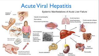 Acute Viral Hepatitis  Diagnosis  Signs and Symptoms  Complication  Treatment [upl. by Patman224]