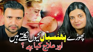 PimplesPhorrun Ka ilaj  Treatment of Boils  The Medbros  DrShoaib  Dr Hera [upl. by Dez6]