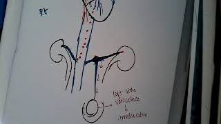 Renal cell carcinoma  renal system [upl. by Dena]