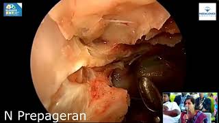 Module 3 Endoscopic Orbital decompression and intraorbital dissection [upl. by Akimik262]