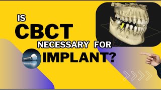 Radiographic Imaging for dental implant CBCT for Dental implant [upl. by Critta]