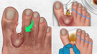 ASMR Cockroaches crawl into toe cracks  Treatment amp Removal Animation [upl. by Nylanej]