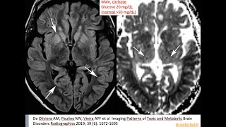 56 Hypoglycemic encephalopathy low glucose thalamic sparing insulin shock therapy [upl. by Deanna]