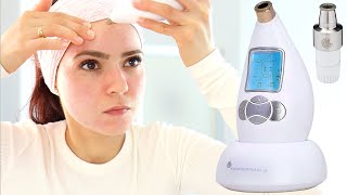 Microderm Glo Review amp How To Use  Microdermabrasion DIY Facial Treatment For Clear Skin [upl. by Bilat896]