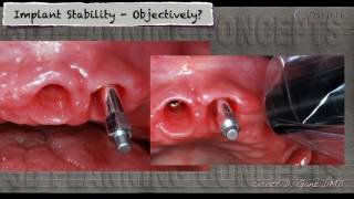 How do you know an implant is ready to be restored [upl. by Gildea933]