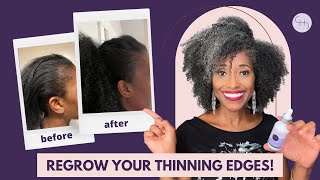 The Ultimate Guide to Regrowing Thinning Hair Edges [upl. by Wildee]