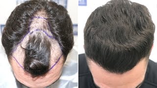 FUE Hair Transplant 1584 Grafts NW III A By Dr Juan Couto  FUEXPERT CLINIC Madrid Spain [upl. by Vallery]