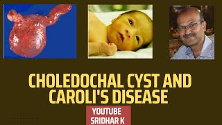 Choledochal cyst and Carolis disease Neonatal cholestasis choledochalcyst carolidisease [upl. by Loise]